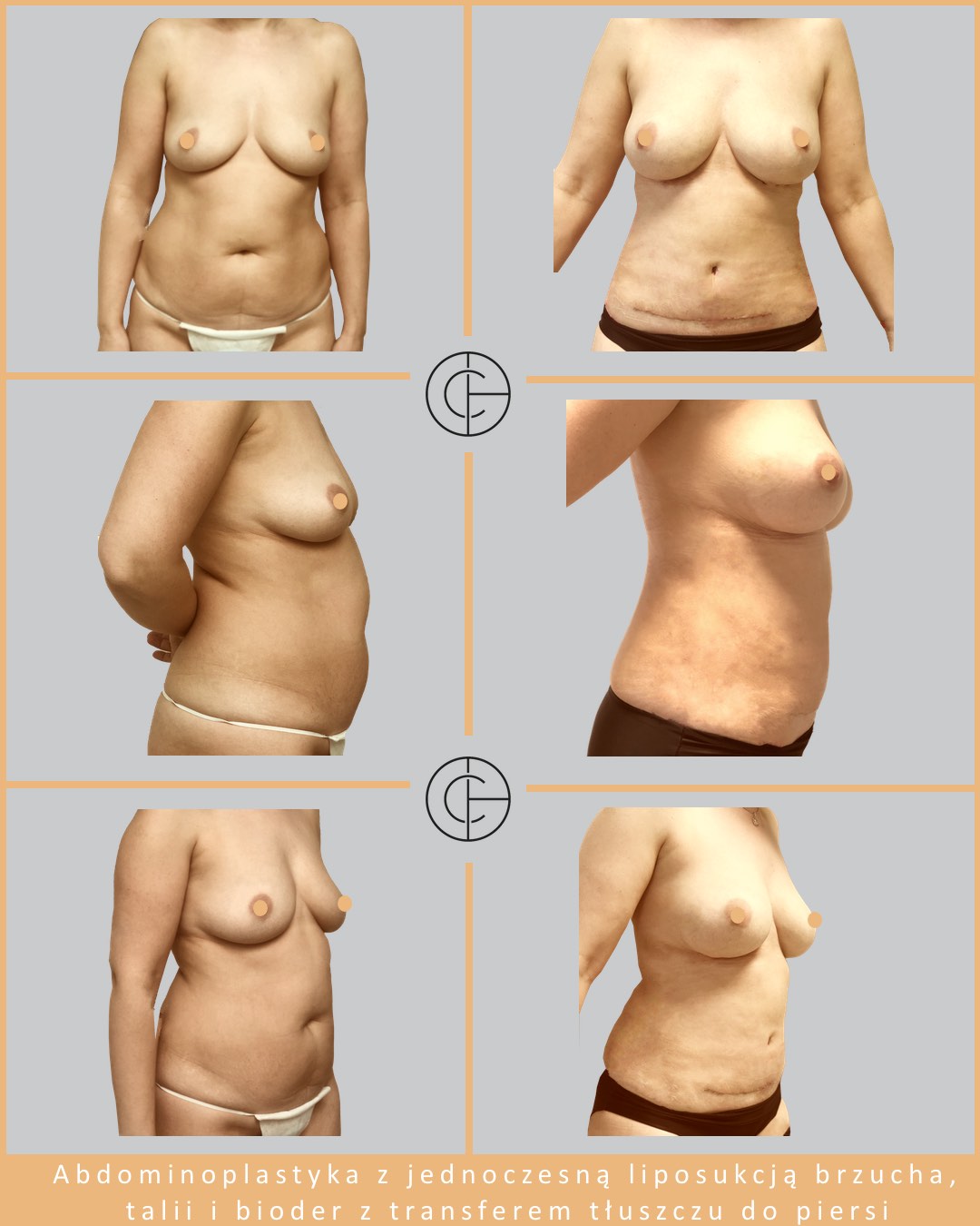 abdominoplastyka z jednoczesną liposukcja brzucha, talii i bioder z transferem tłuszczu do piersi 2JPG